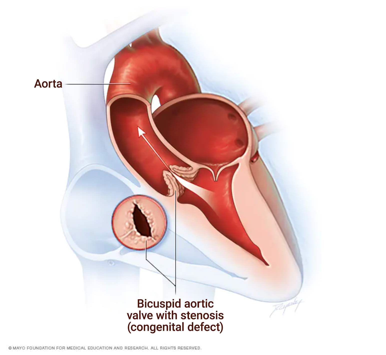 Bicuspid Aortic Valve Syndrome Signs And Symptoms Marfan Foundation