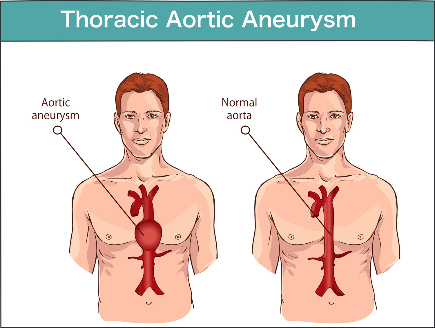 how is a thoracic aortic aneurysm repair