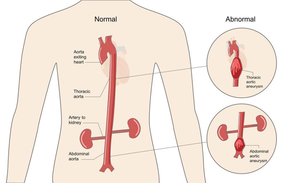 Thoracic Aortic Aneurysm And Aortic Dissection Marfan Foundation