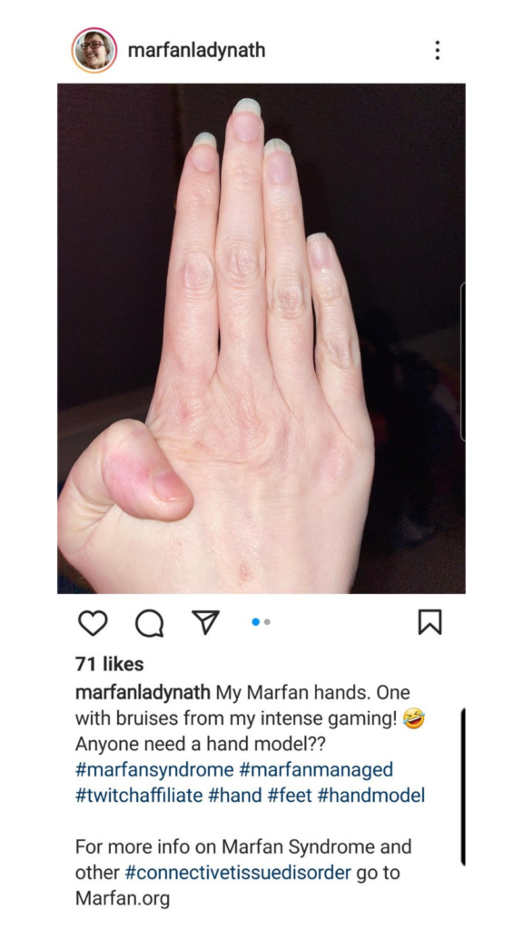 marfan syndrome hands